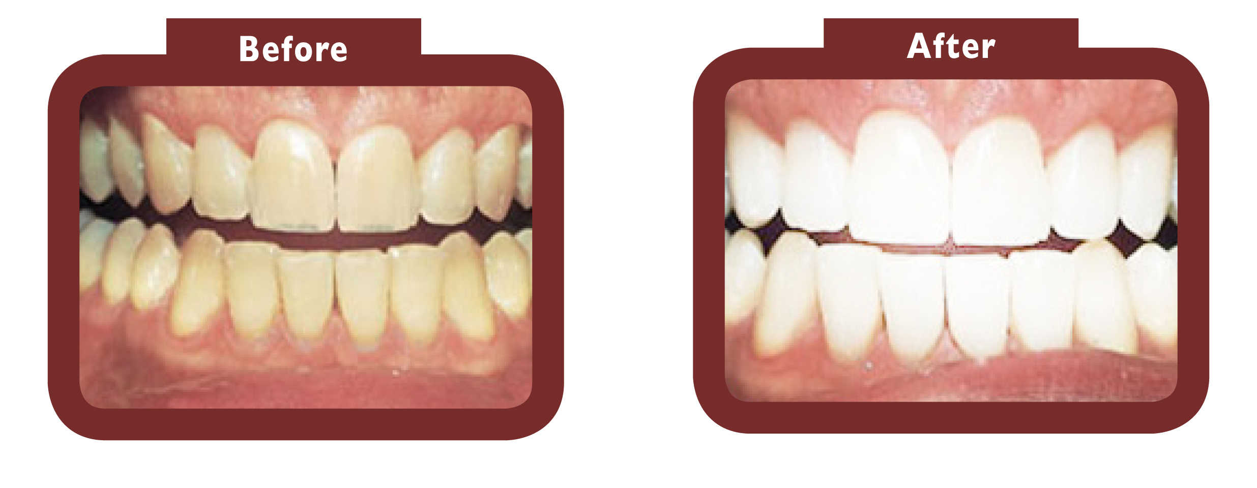 before and after teeth whitening - LA TEETH Sussex