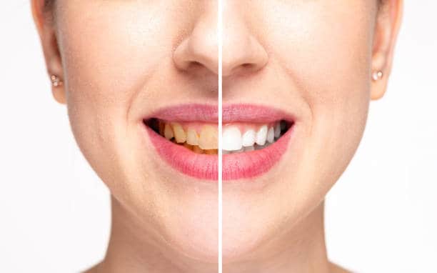 Teeth Whitening Milton Keynes Sussex