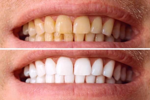 Laser White For Ever Bright – Get a Brighter, Whiter Smile with LA Teeth Whitening Sussex