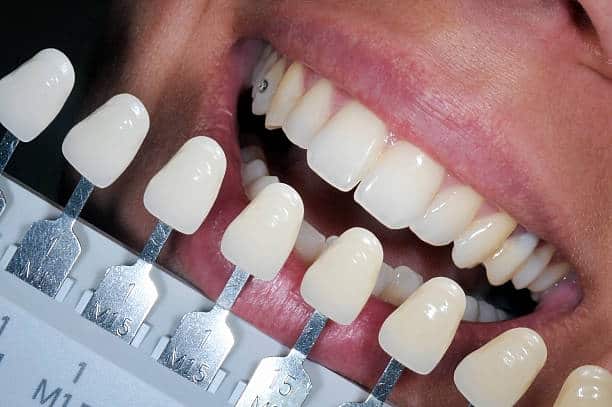 Get Natural and Stunning Smile with Teeth Whitening Results from LA Teeth Whitening Sussex