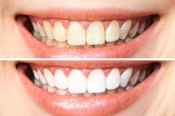 Achieve a Dazzling Smile for Your Special Day: A Guide to Wedding Teeth Whitening Sussex