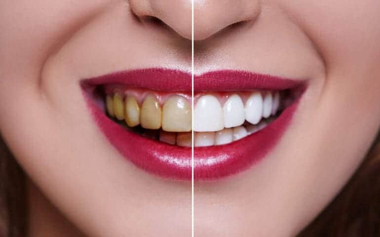 Teeth Whitening Ascot Windsor Sussex