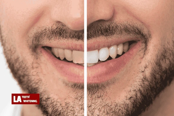 Book in for laser whitening today! Sussex