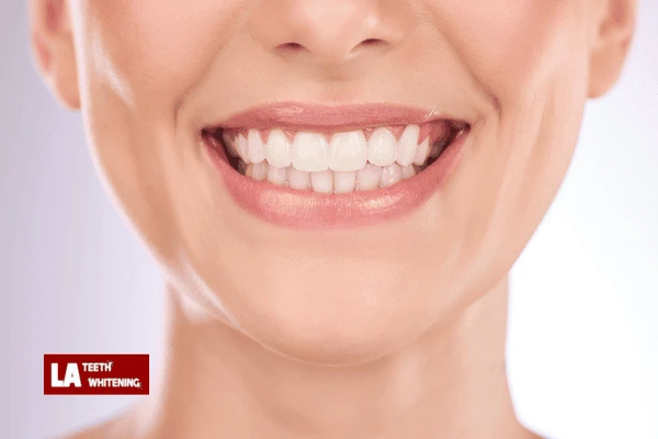 What is laser whitening Sussex? Sussex