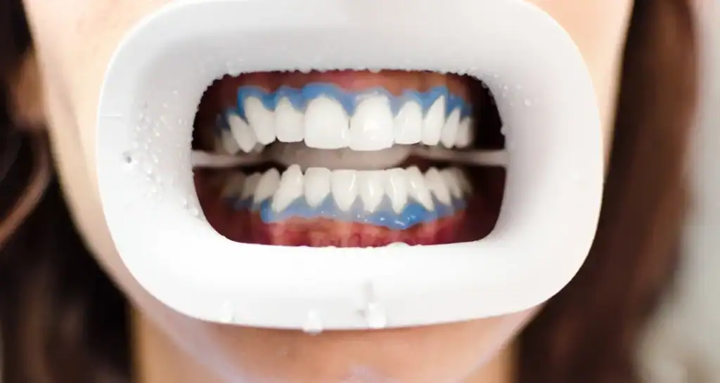 Is Professional Whitening Better Than At-Home Kits Sussex